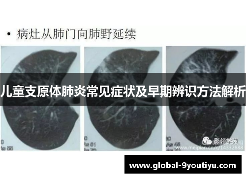儿童支原体肺炎常见症状及早期辨识方法解析